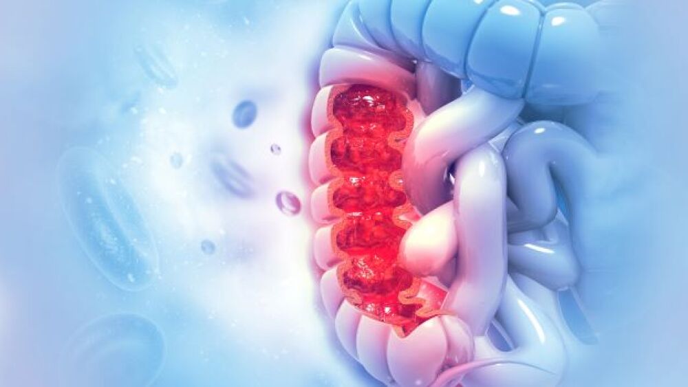 Colon Cancer